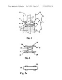 Modular Prostheses and Method for the Implantation of Modular Prostheses diagram and image