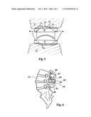 Modular Prostheses and Method for the Implantation of Modular Prostheses diagram and image