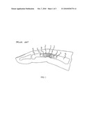 ARTIFICIAL JOINT diagram and image