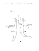 Surgical Implant diagram and image