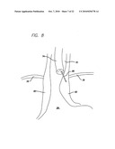 Surgical Implant diagram and image