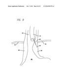 Surgical Implant diagram and image