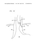 Surgical Implant diagram and image