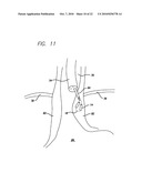 Surgical Implant diagram and image