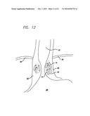 Surgical Implant diagram and image