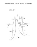 Surgical Implant diagram and image