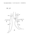 Surgical Implant diagram and image