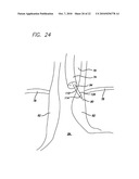 Surgical Implant diagram and image