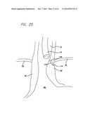 Surgical Implant diagram and image