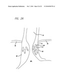 Surgical Implant diagram and image