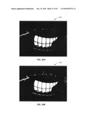 Ocular surface interferometry (OSI) methods for imaging and measuring ocular tear film layer thickness(es) diagram and image