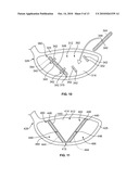 GOLF CLUB HEAD OR OTHER BALL STRIKING DEVICE HAVING STIFFENED FACE PORTION diagram and image