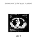 UTILIZATION OF MURAL THROMBUS FOR LOCAL DRUG DELIVERY INTO VASCULAR TISSUE diagram and image