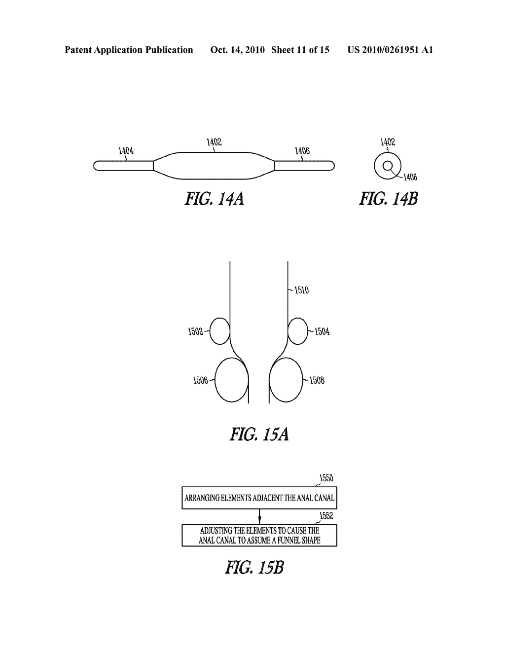 METHOD AND APPARATUS FOR AN ADJUSTABLE IMPLANTABLE CONTINENCE DEVICE - diagram, schematic, and image 12