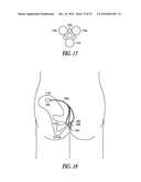 METHOD AND APPARATUS FOR AN ADJUSTABLE IMPLANTABLE CONTINENCE DEVICE diagram and image