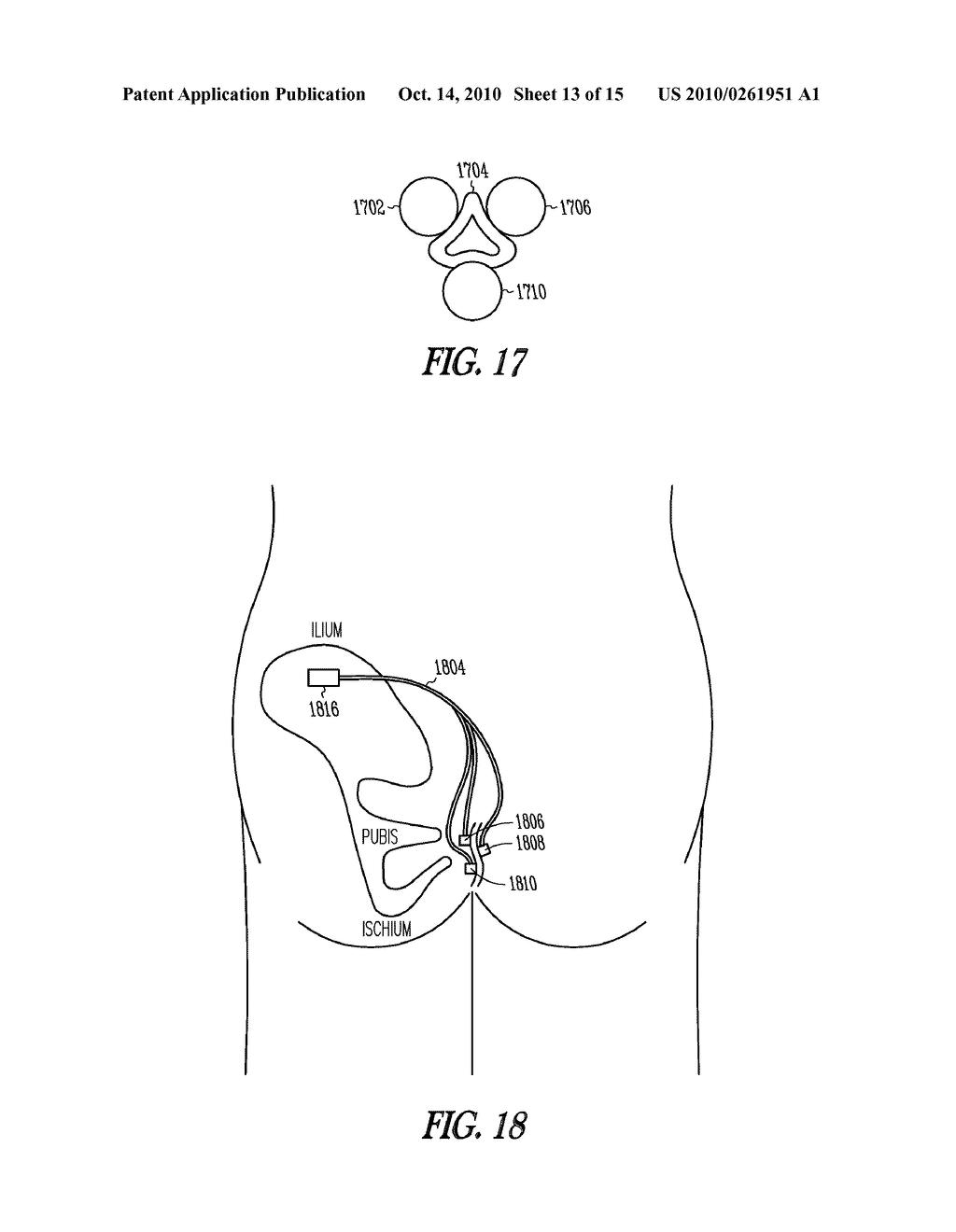 METHOD AND APPARATUS FOR AN ADJUSTABLE IMPLANTABLE CONTINENCE DEVICE - diagram, schematic, and image 14