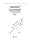 METHOD AND APPARATUS FOR AN ADJUSTABLE IMPLANTABLE CONTINENCE DEVICE diagram and image