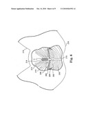 Surgical articles and methods for treating pelvic conditions diagram and image