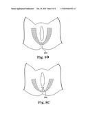Surgical articles and methods for treating pelvic conditions diagram and image