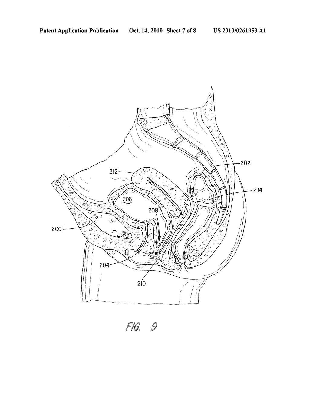 APPARATUS AND METHOD FOR PELVIC FLOOR REPAIR IN THE HUMAN FEMALE - diagram, schematic, and image 08