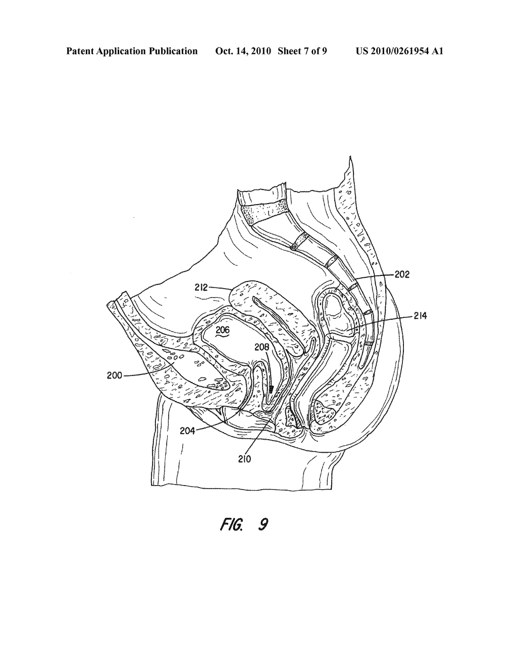 Apparatus and Method for Pelvic Floor Repair in the Human Female - diagram, schematic, and image 08