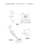 HIP IMPLANT REGISTRATION IN COMPUTER ASSISTED SURGERY diagram and image