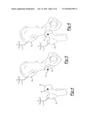 HIP IMPLANT REGISTRATION IN COMPUTER ASSISTED SURGERY diagram and image