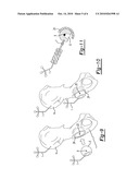 HIP IMPLANT REGISTRATION IN COMPUTER ASSISTED SURGERY diagram and image