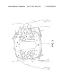 BACK BRACE diagram and image