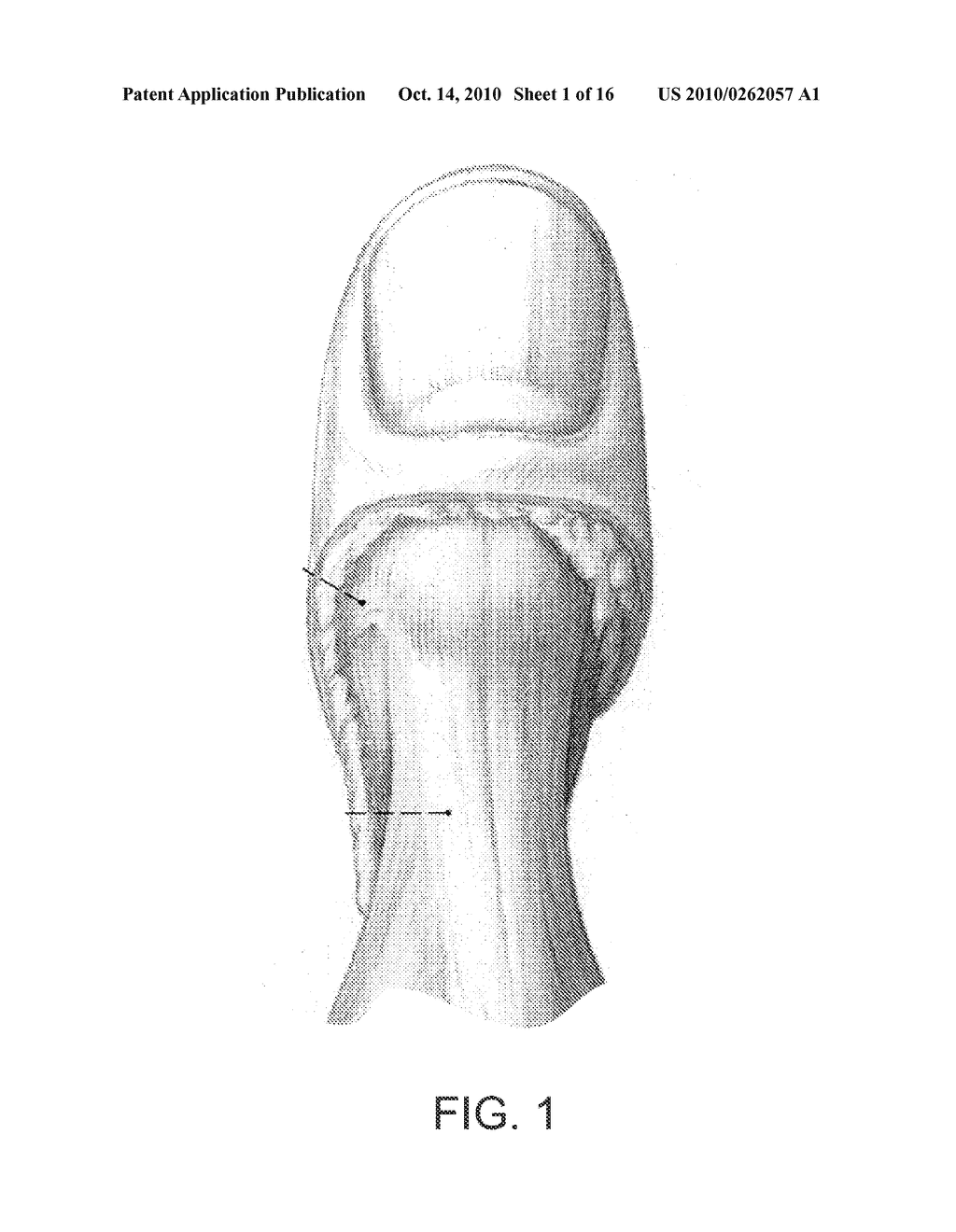 SPLINT COMPOSITION AND METHOD FOR USING SAME - diagram, schematic, and image 02