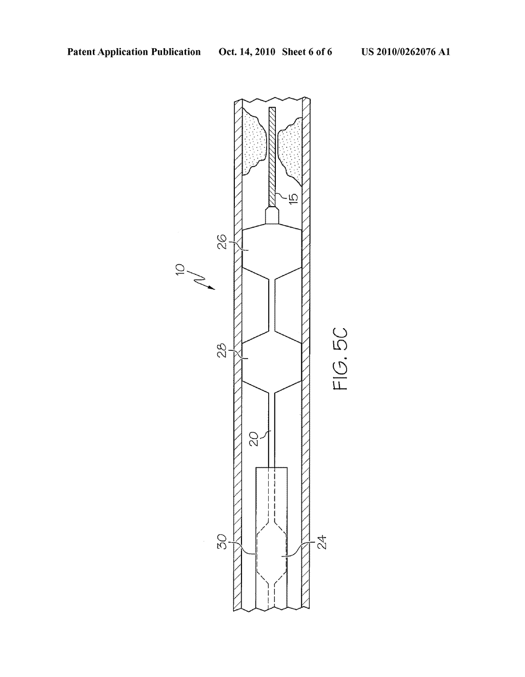 Balloon Catheter - diagram, schematic, and image 07