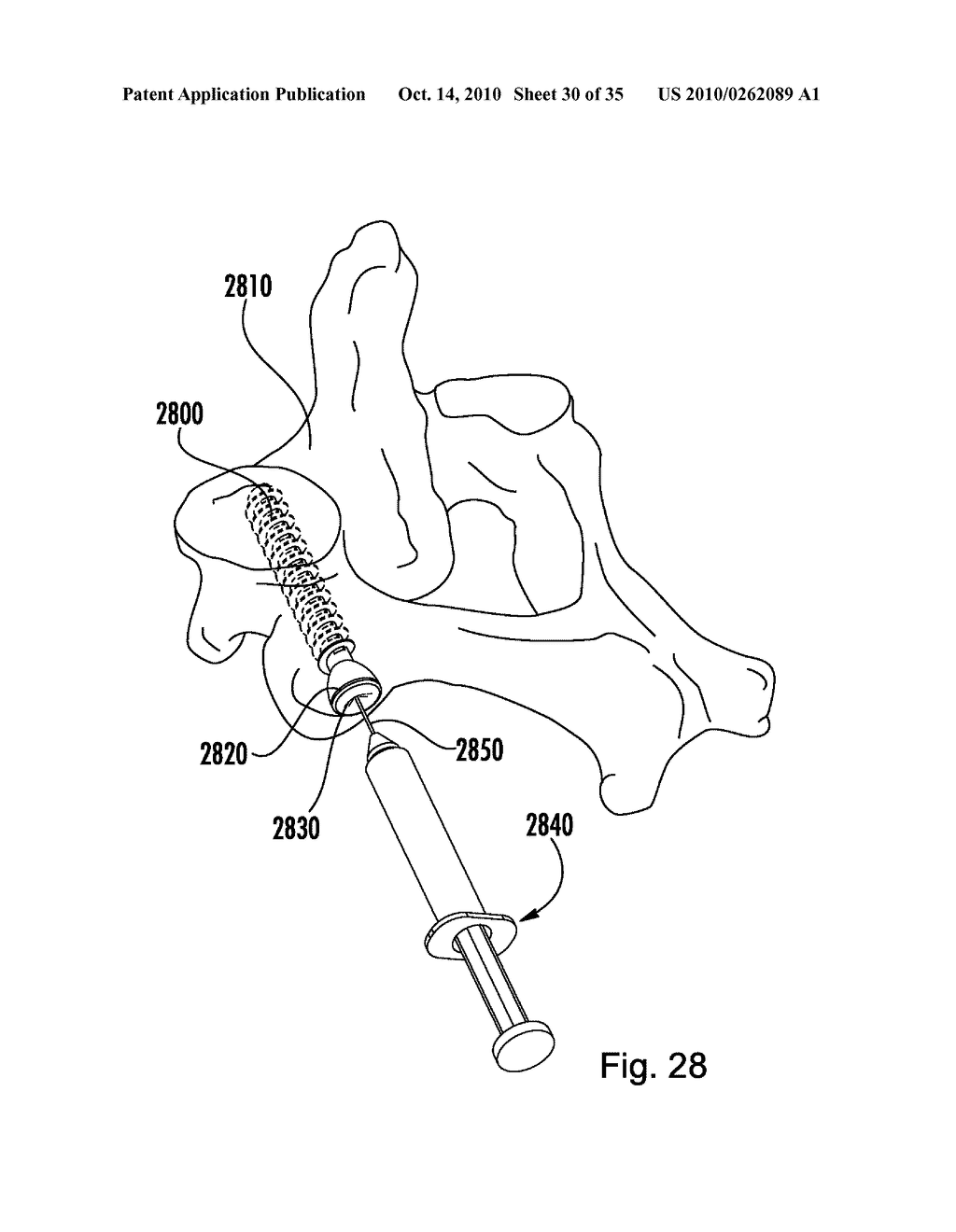 METHOD AND DEVICE FOR DELIVERING MEDICINE TO BONE - diagram, schematic, and image 31