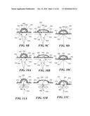 METHODS AND DEVICES FOR APPLYING CLOSED INCISION NEGATIVE PRESSURE WOUND THERAPY diagram and image