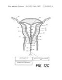 MEDICAL SYSTEMS AND METHODS FOR ABLATING AND ABSORBING TISSUE diagram and image