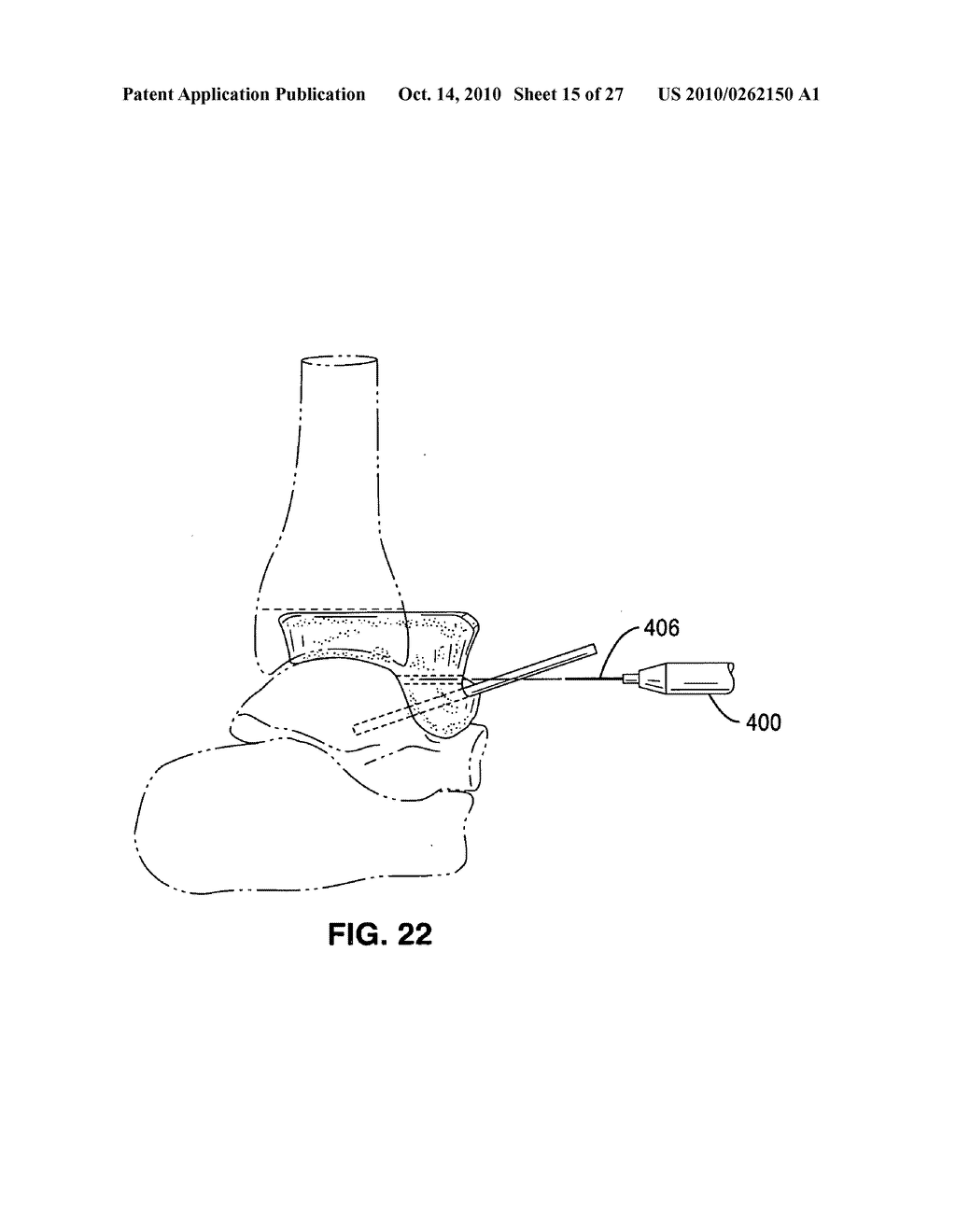 Custom radiographically designed cutting guides and instruments for use in total ankle replacement surgery - diagram, schematic, and image 16