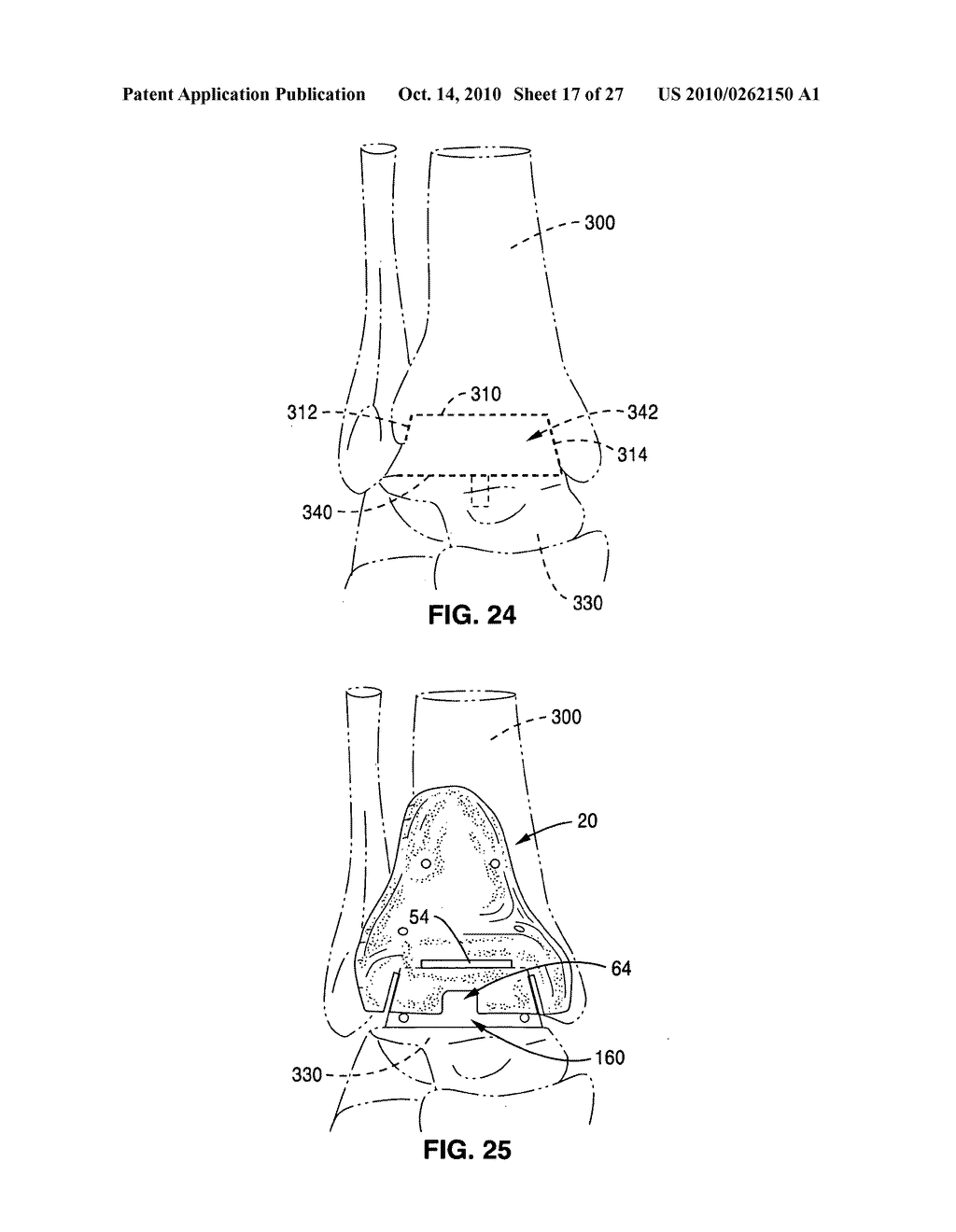 Custom radiographically designed cutting guides and instruments for use in total ankle replacement surgery - diagram, schematic, and image 18