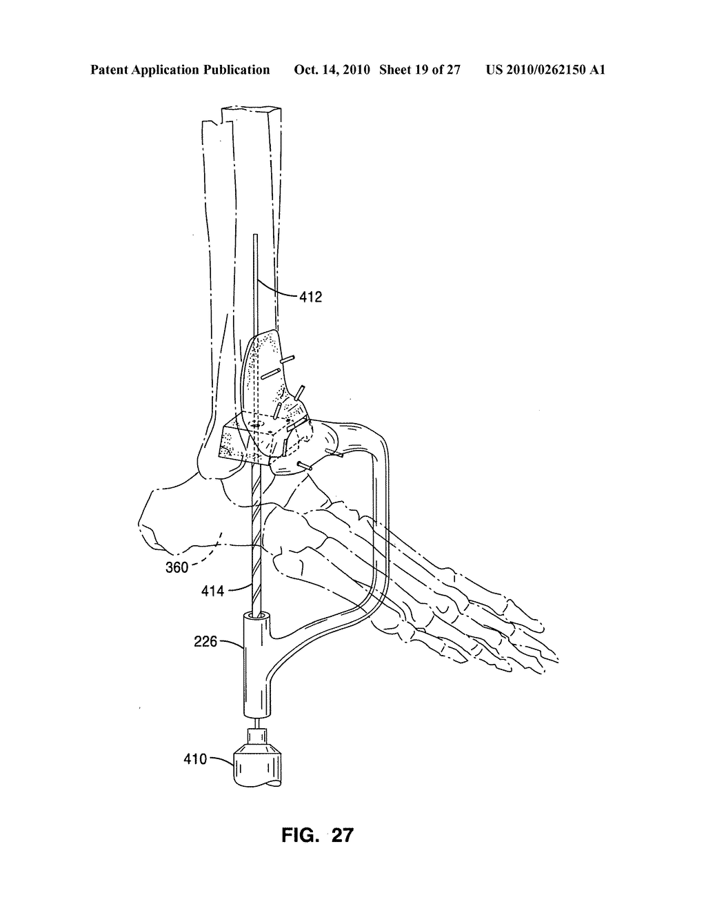 Custom radiographically designed cutting guides and instruments for use in total ankle replacement surgery - diagram, schematic, and image 20