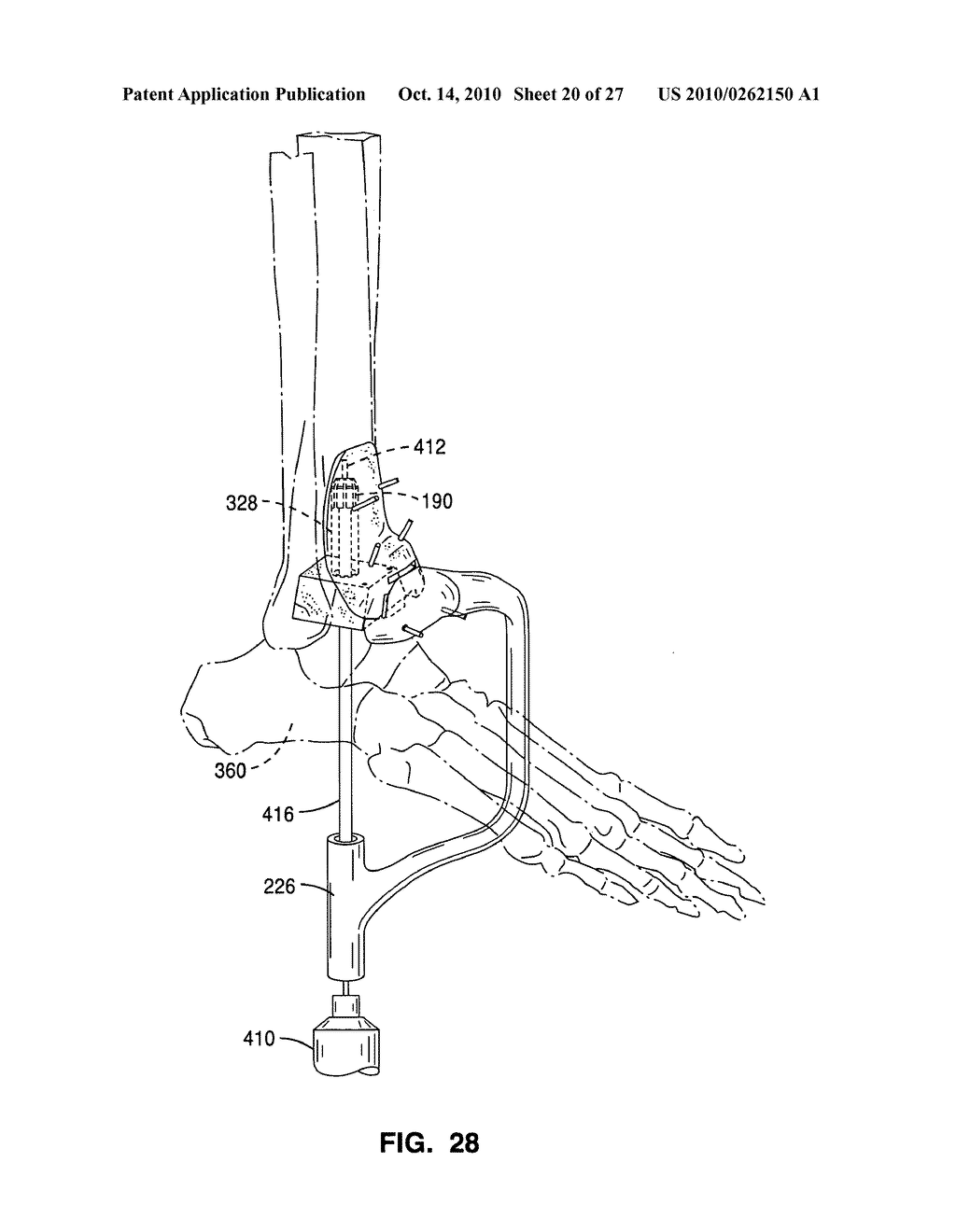 Custom radiographically designed cutting guides and instruments for use in total ankle replacement surgery - diagram, schematic, and image 21