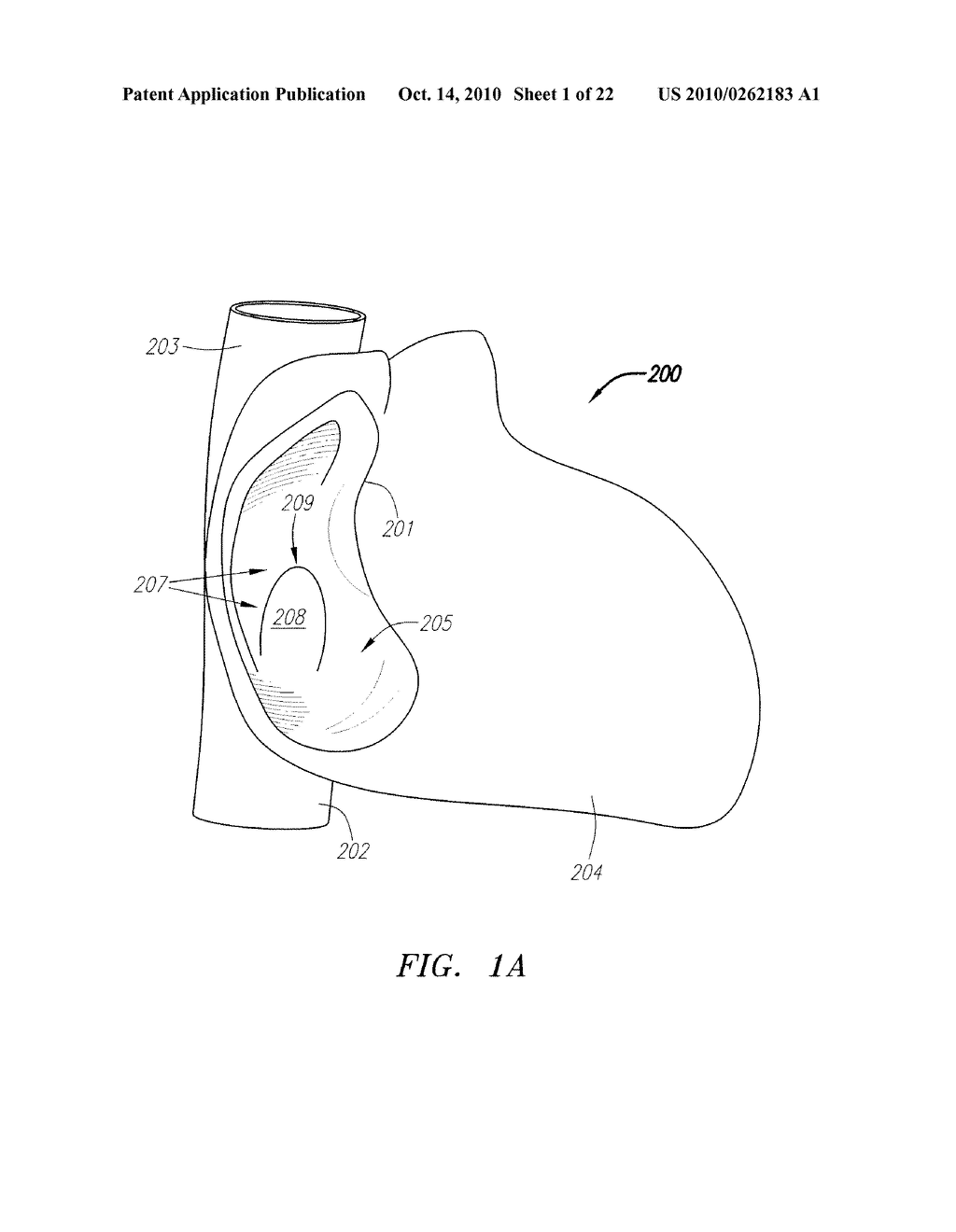SYSTEMS DEVICES AND METHODS FOR ACHIEVING TRANSVERSE ORIENTATION IN THE TREATMENT OF SEPTAL DEFECTS - diagram, schematic, and image 02