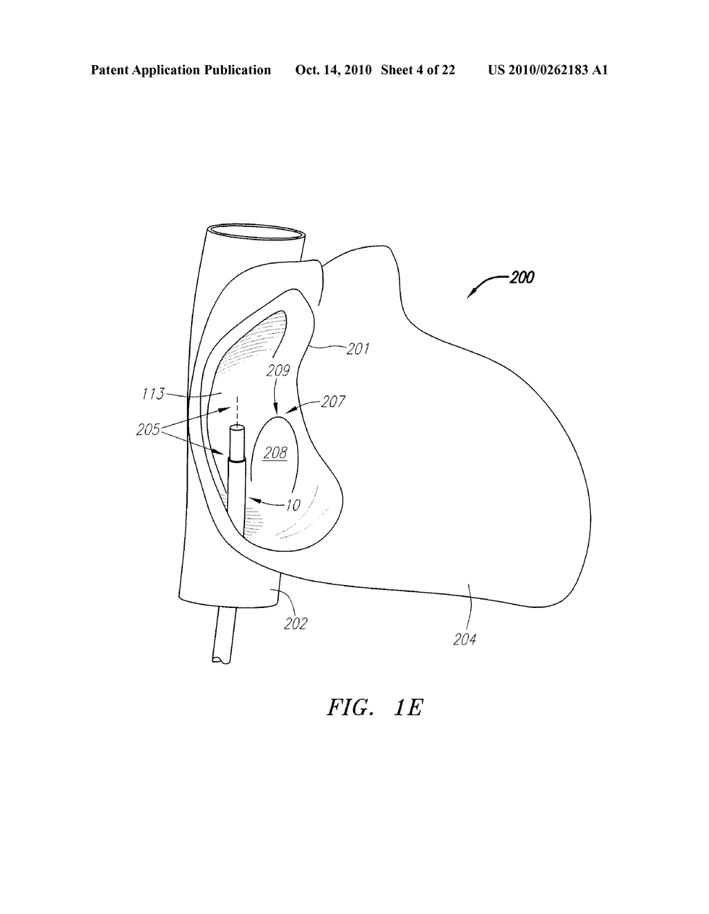 SYSTEMS DEVICES AND METHODS FOR ACHIEVING TRANSVERSE ORIENTATION IN THE TREATMENT OF SEPTAL DEFECTS - diagram, schematic, and image 05
