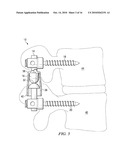 SYSTEMS AND DEVICES FOR DYNAMIC STABILIZATION OF THE SPINE diagram and image