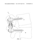 SYSTEMS AND DEVICES FOR DYNAMIC STABILIZATION OF THE SPINE diagram and image