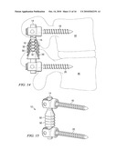 SYSTEMS AND DEVICES FOR DYNAMIC STABILIZATION OF THE SPINE diagram and image