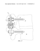 SYSTEMS AND DEVICES FOR DYNAMIC STABILIZATION OF THE SPINE diagram and image