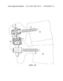 SYSTEMS AND DEVICES FOR DYNAMIC STABILIZATION OF THE SPINE diagram and image