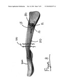 CLAVICLE NAIL WITH LOCKING END CAP diagram and image