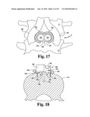 Methods and instrumentation for vertebral interbody fusion diagram and image