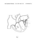 Mitral Valve Coaptation Plate For Mitral Valve Regurgitation diagram and image