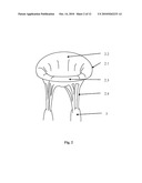 Mitral Valve Coaptation Plate For Mitral Valve Regurgitation diagram and image