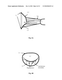 Mitral Valve Coaptation Plate For Mitral Valve Regurgitation diagram and image